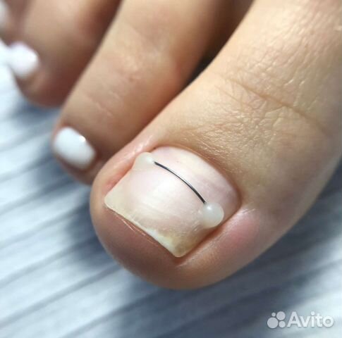 Коррекция вросшего ногтя Подолог