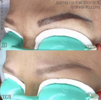 Удаление старого татуажа лазером и ремувером